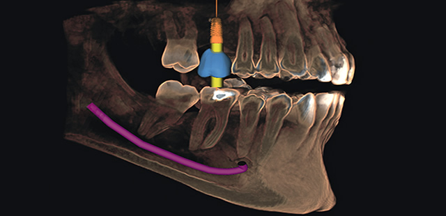 Tomogra&iacute;ia Cone Bean